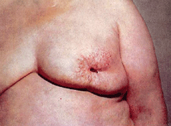 Симптом умбиликации