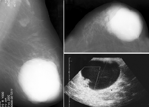 Разные лучевые методы в диагностике РМЖ