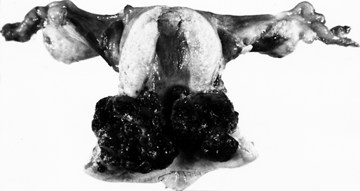 Опухолевый узел хориокарциномы в матке