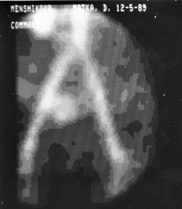 Ангиостинциграфическая визуализация трофобластической опухоли