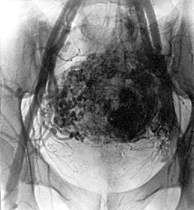 Тазовая ангиография у больной трофобластической опухолью
