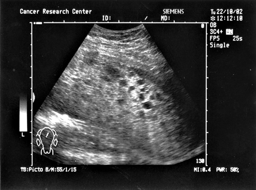 Ультразвуковая томограмма больной с пузырным заносом