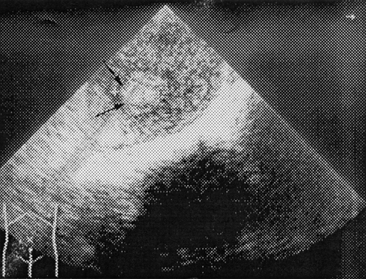 Ультразвуковая томограмма больной с хориокарциномой матки