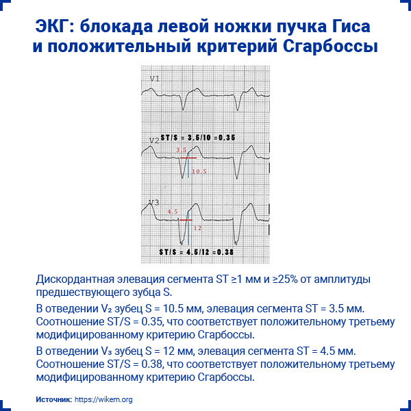 Полная блокада пучка ножки гиса лечение