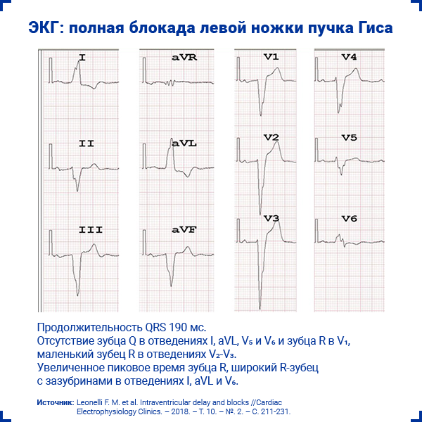 Блокада левой ножки п гиса