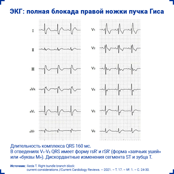 Блокада левой ножки п гиса