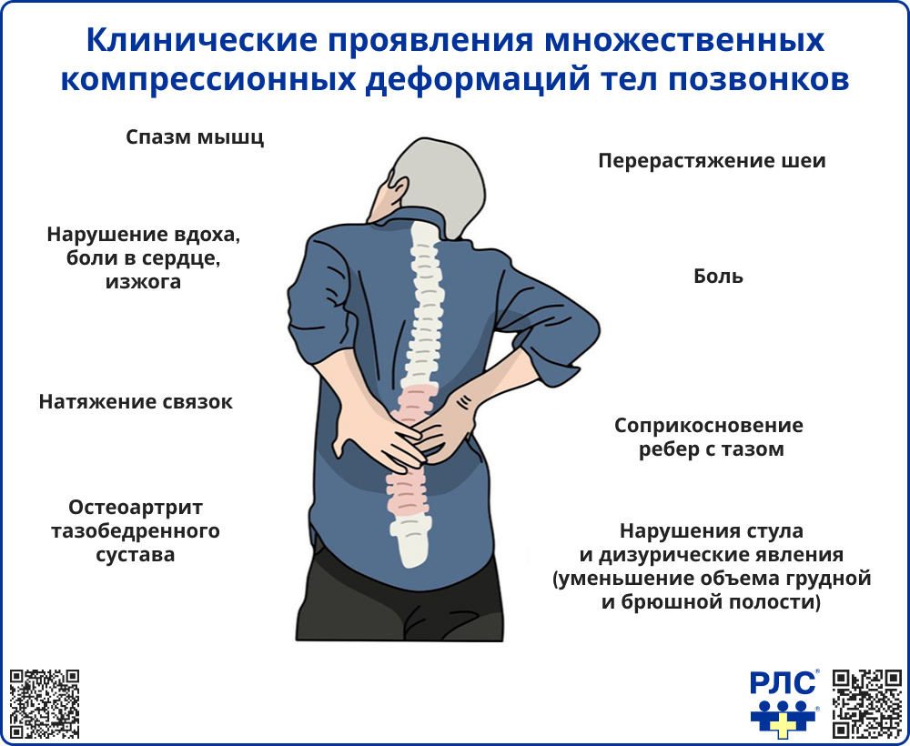 Клинические проявления множественных компрессионных деформаций тел позвонков