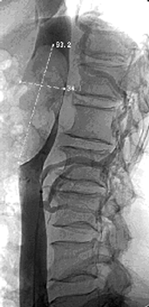 Кавограмма больного с опухолевым тромбом, достигающим диафрагмы