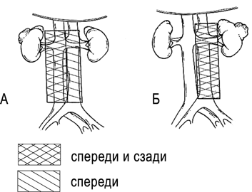 Границы расширенной лимфаденэктомии при раке правой (A) и левой (Б) почек
