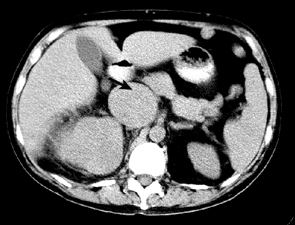 КТ больного раком правой почки с опухолевым тромбозом НПВ