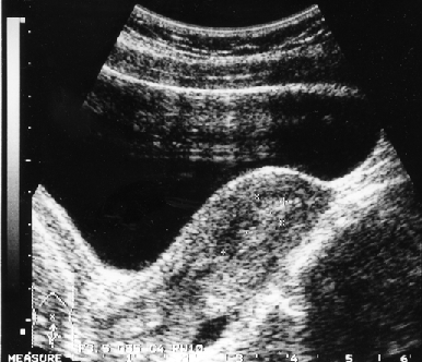 Ультразвуковые признаки инвазии опухоли в миометрий