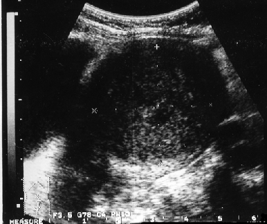 Прорастание рака эндометрия всех оболочек матки