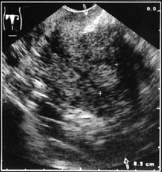 Локализация опухоли в дне матки в виде полипа