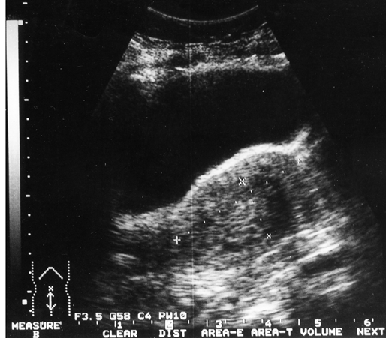 Тотальное поражение полости матки с переходом на цервикальный канал