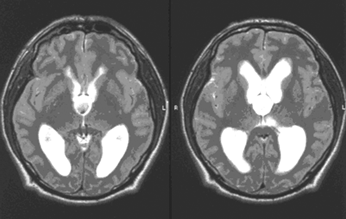 МР-томография больного с коллоидной кистой III желудочка, выраженной гидроцефалией