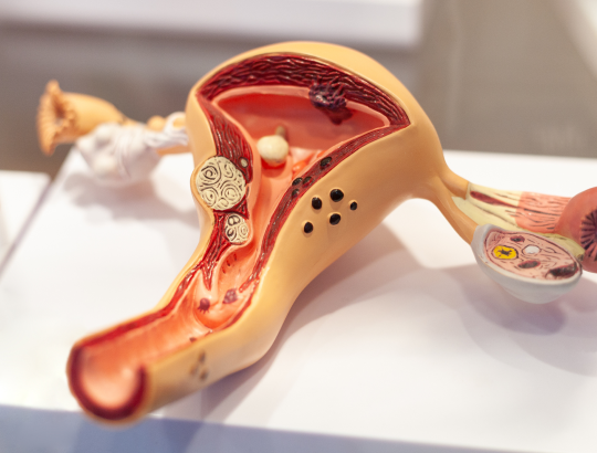 Миома матки: новая информация для специалистов