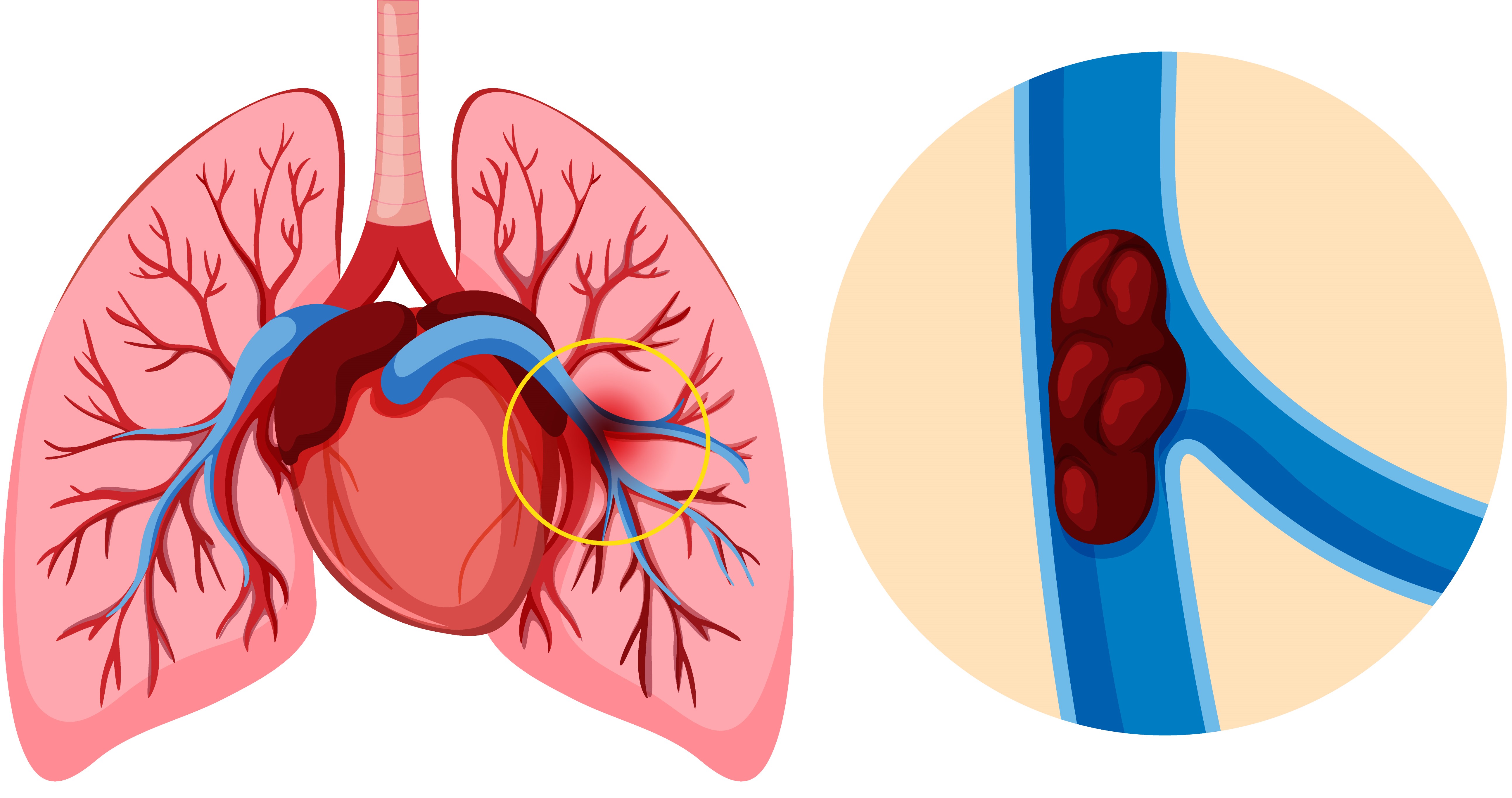 Новый калькулятор «Пересмотренная Женевская шкала»