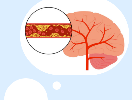 Новый калькулятор «Шкала инсульта Национального института здоровья»