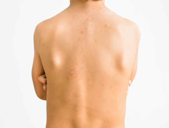 Миноциклин: постмаркетинговый опыт