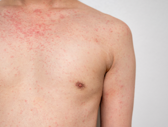 Иксекизумаб: постмаркетинговый опыт