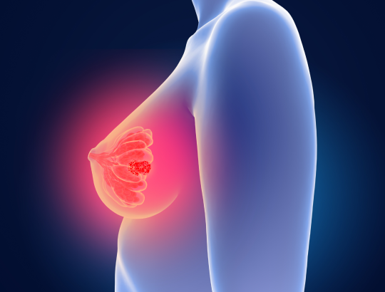 Новый калькулятор «Шкала BI-RADS»