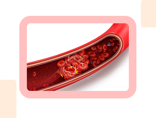Новый калькулятор: «Шкала Padua»