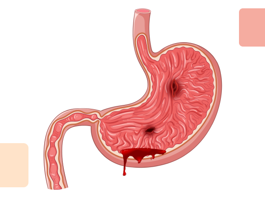 Новый калькулятор: Шкала Rockall