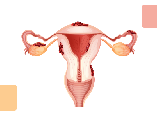 Новый калькулятор: индекс фертильности эндометриоза