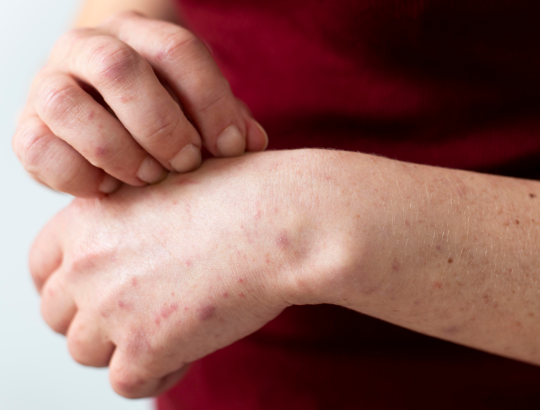 Аброцитиниб — новое описание ДВ