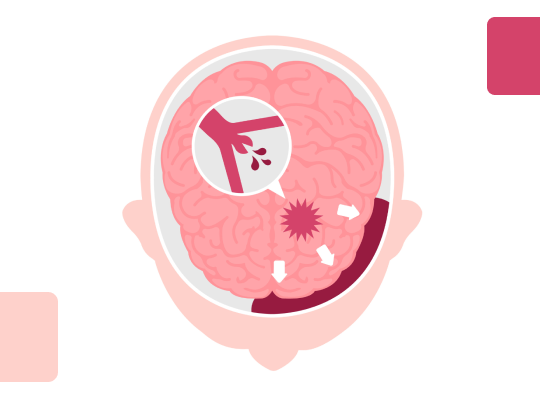 Новый калькулятор: Шкала Ханта-Хесса