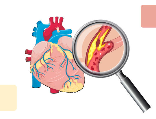 Новый калькулятор: Голландские диагностические критерии семейной гиперхолестеринемии