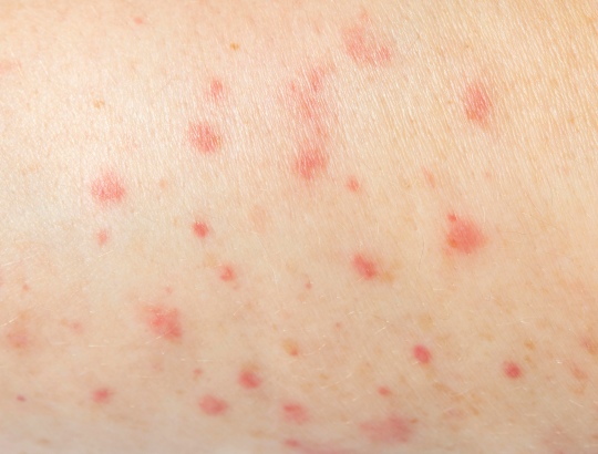 Розовый лишай Жибера: новая информация для специалистов